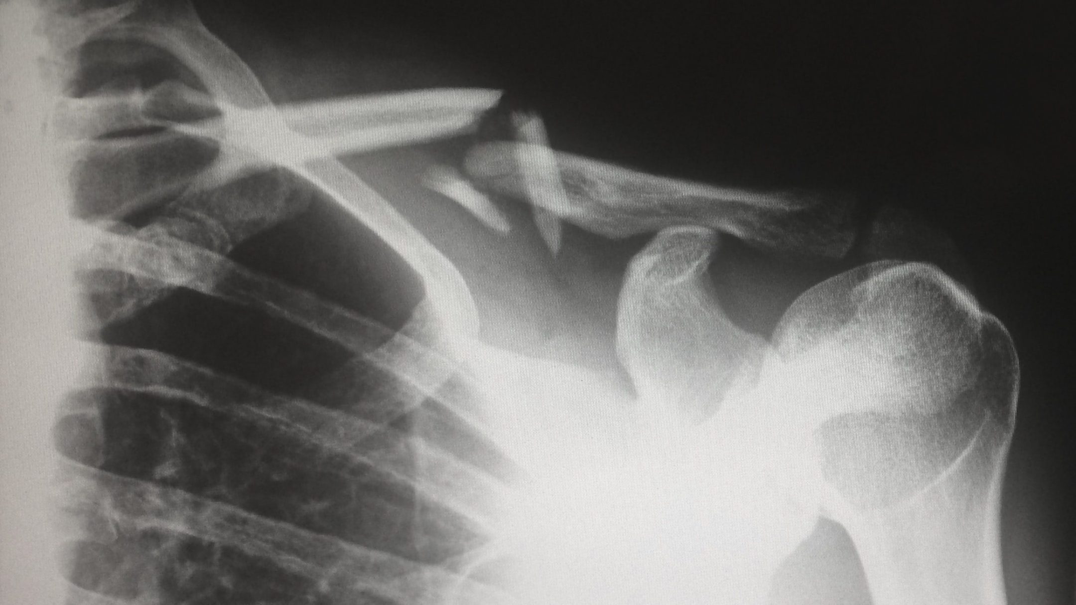 black and white x ray of a broken human clavicle
