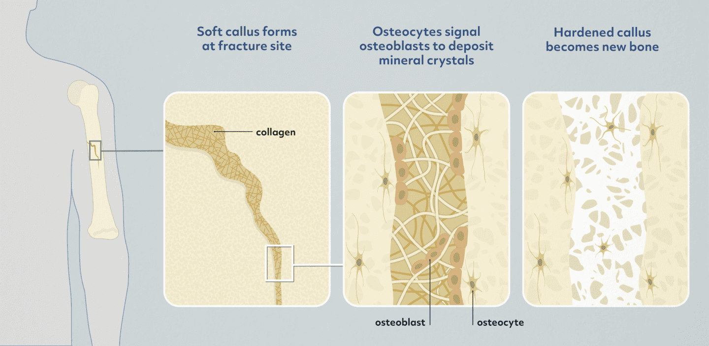 A science illustration of the bone healing process.